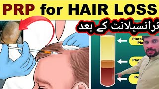 PRP Hair treatment again naya pakistan Khuram Abbas [upl. by Ennaear]