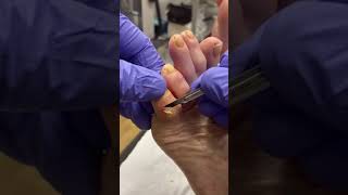 Corn Removal by Podiatrist Expert Solutions for Little Toe Corns [upl. by Bobbee499]