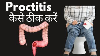 Proctitis symptoms and treatment in Hindi  proctitis kya hai  proctitis ka ilaaj [upl. by Healey362]