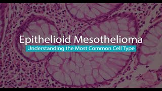 Epithelioid Mesothelioma  Mesothelioma Hope [upl. by Espy412]