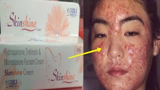 Skin Shine CREAM SIDE EFFECTS के कारण  Reason of SIDE EFFECTS  How to Remove side effects  Hindi [upl. by Neros]