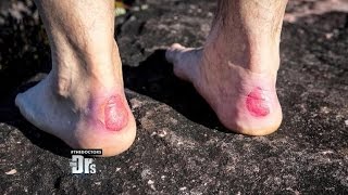 Drs Rx How to Avoid Getting Blisters on Your Feet [upl. by Orelia]