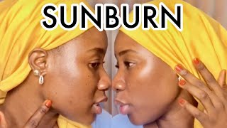 Sunburn Treatment For Black Skin  How To Clear Sunburn Fast [upl. by Lertnahs]