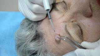 Intra dermal nevus  removal by highfrequency electrosurgery [upl. by Newlin]