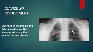 CLEIDOCRANIAL DYSPLASIA  Xray  Radiology [upl. by Montague]