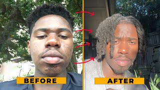 How I FINALLY Got Rid of My Acne [upl. by Erodoeht]