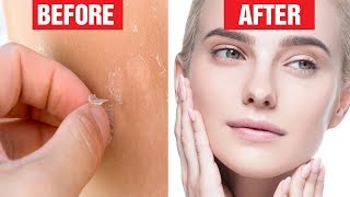 8 Best Ways to Get Rid Of Peeling Skin on Face [upl. by Burrton]