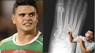 Latrell Mitchell LISFRANC FOOT INJURY Explained Will he need SURGERY [upl. by Anelle699]