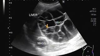 Ultrasound Video showing Hepatic hydatid cyst with a solid mass [upl. by Nikola]