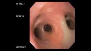 Veterinary Bronchoscopy457 Diffuse Bronchiectasis Chronic cough Labrador Retriever 5y M [upl. by Akemihs]