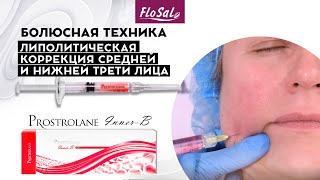 Липолитическая коррекция средней и нижней трети лица  техника иглы Prostrolane InnerB [upl. by Maxi]