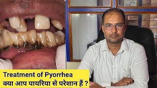 What is pyorrheaTreatment of pyorrhea  क्पा होता है पायरिया  पायरिया का इलाज  medical dental [upl. by Adelbert]