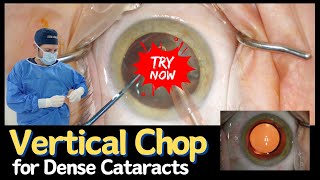 Vertical Chop  A Technique for Dense Cataracts [upl. by Akemat184]