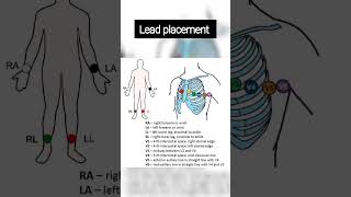 POSITION of 12 LEAD ECG 12leadecgplacementpositionofecgleadsecginterpretationelectrocardiogram [upl. by Aihsenot]