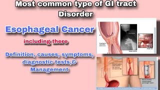 Understanding Esophageal Cancer  Symptoms Diagnosis and Treatment [upl. by Erodeht]