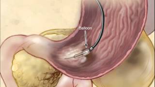 Infected Necrotizing Pancreatitis  Treatment By Endoscopic Transgastric Necrosectomy [upl. by Latvina]