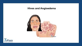 Hives and Angioedema [upl. by Nageet249]