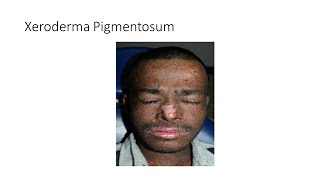 Xeroderma Pigmentosum [upl. by Divan]