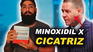 MINOXIDIL X CICATRIZ  COMO RESOLVER ESSE PROBLEMA  BARBA PRETA [upl. by Ynattir487]