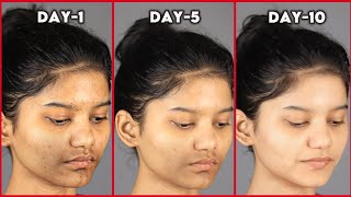 Get EVEN TONED Glowing Skin Naturally  Remove PIGMENTATION amp DARK PATCHES Around Mouth Permanently [upl. by Eicaj]