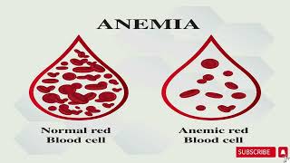 Iron deficiency anemia انيميا نقص الحديد [upl. by Lerad886]