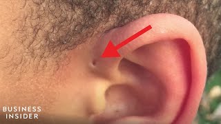 Explaining A Preauricular Sinus A Tiny Hole Above Some Peoples Ears [upl. by Ellecrad92]