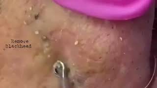 Blackhead Removal on Lips amp Nose  Get Smooth Clear Skin  removeblackhead [upl. by Thadeus]