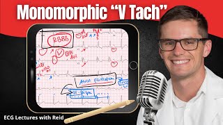 Monomorphic Ventricular Tachycardia VT EKG  ECG Lecture [upl. by Eckardt875]