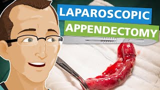 Laparoscopic Appendectomy [upl. by Rocker300]