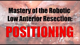 Robotic Low Anterior Resection Patient Positioning and Room Setup [upl. by Oina789]