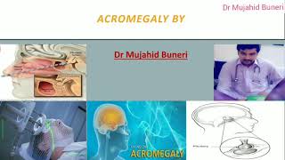 Achieve Mastery In Acromegaly Within 10 Minutes  Dr M B [upl. by Calder]