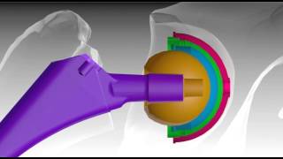 Hip Implant Failure Cause amp Process [upl. by Notlit223]