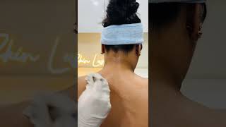 Chemical peel for body pigmentation pigmentationtrending skinpigmentation underarmpigmentation [upl. by Ayimat]