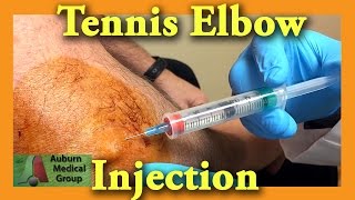 Tennis Elbow Cortisone Injection  Auburn Medical Group [upl. by O'Malley]