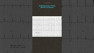 ECG Diagnosis [upl. by Karola]