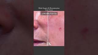 Scar Revision following MOHs Reconstructive Surgery  Dr Hooman Khorasani [upl. by Delle]