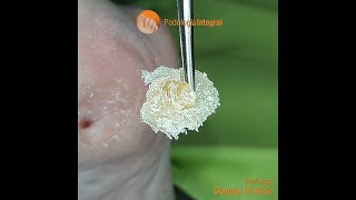 Thorough extraction of a foot corn  Podological treatment extract [upl. by Nylia]