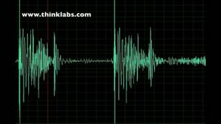 Subaortic Stenosis [upl. by Matthieu]