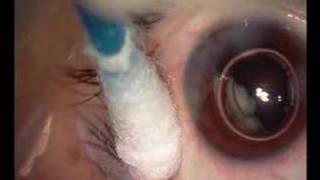 intravitreal TSA injection [upl. by Geesey]