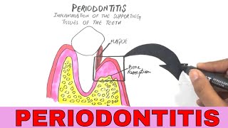 Periodontal Disease  Pathogenesis [upl. by Motteo]