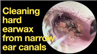 Cleaning hard earwax from narrow ear canalsear wax removal  ear cleaning  ASMR  relaxation [upl. by Celeste574]