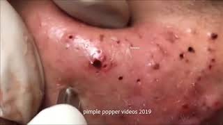 Multiply blackheads on the forehead remove blackheads Blackheads Removal [upl. by Ynaffat841]