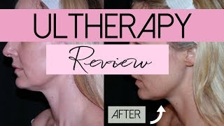 Ultherapy  NonInvasive Face Lift Treatment  Review  BusbeeStyle TV [upl. by Roshelle]