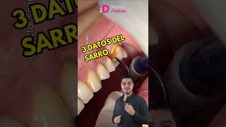 Sarro en los dientes limpiezadental dientesperfectos dientesperfectos shorts dentista [upl. by Darla]