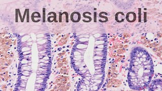 What is Melanosis Coli  Pathology mini tutorial [upl. by Barnet]