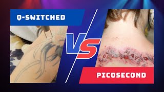 Picosecond VS Q Switched Lasers  Whats The Difference [upl. by Leuas]