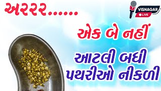 અરરરએક બે નહીં પિત્તાશયમાંથી આટલી બધી પથરીઓ નીકળી [upl. by Ennovahc]