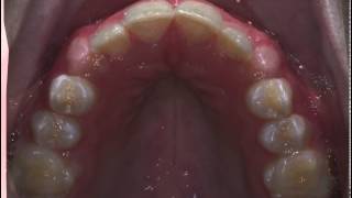 Orthodontic Expansion without a palatal expander [upl. by Bunde92]