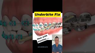 Elastics to Fix Your Underbite Heres How dentallan dentist shorts [upl. by Ybba]