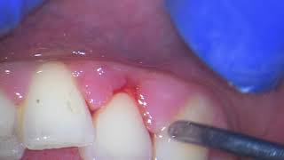 Ultrasonic teeth cleaning watch why your gums bleed [upl. by Mikkanen]